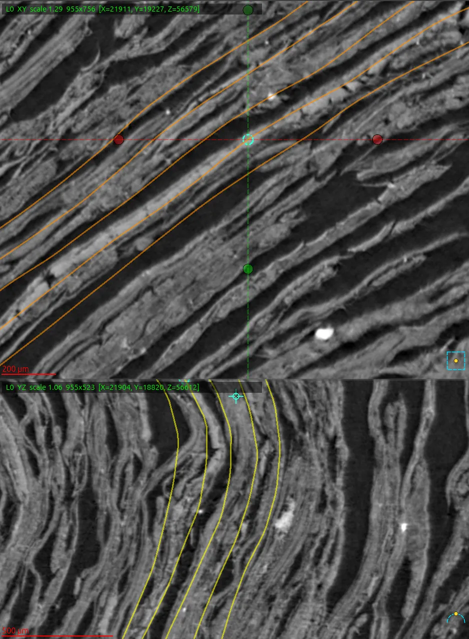 A kolleisis join viewed in two CT volume slices